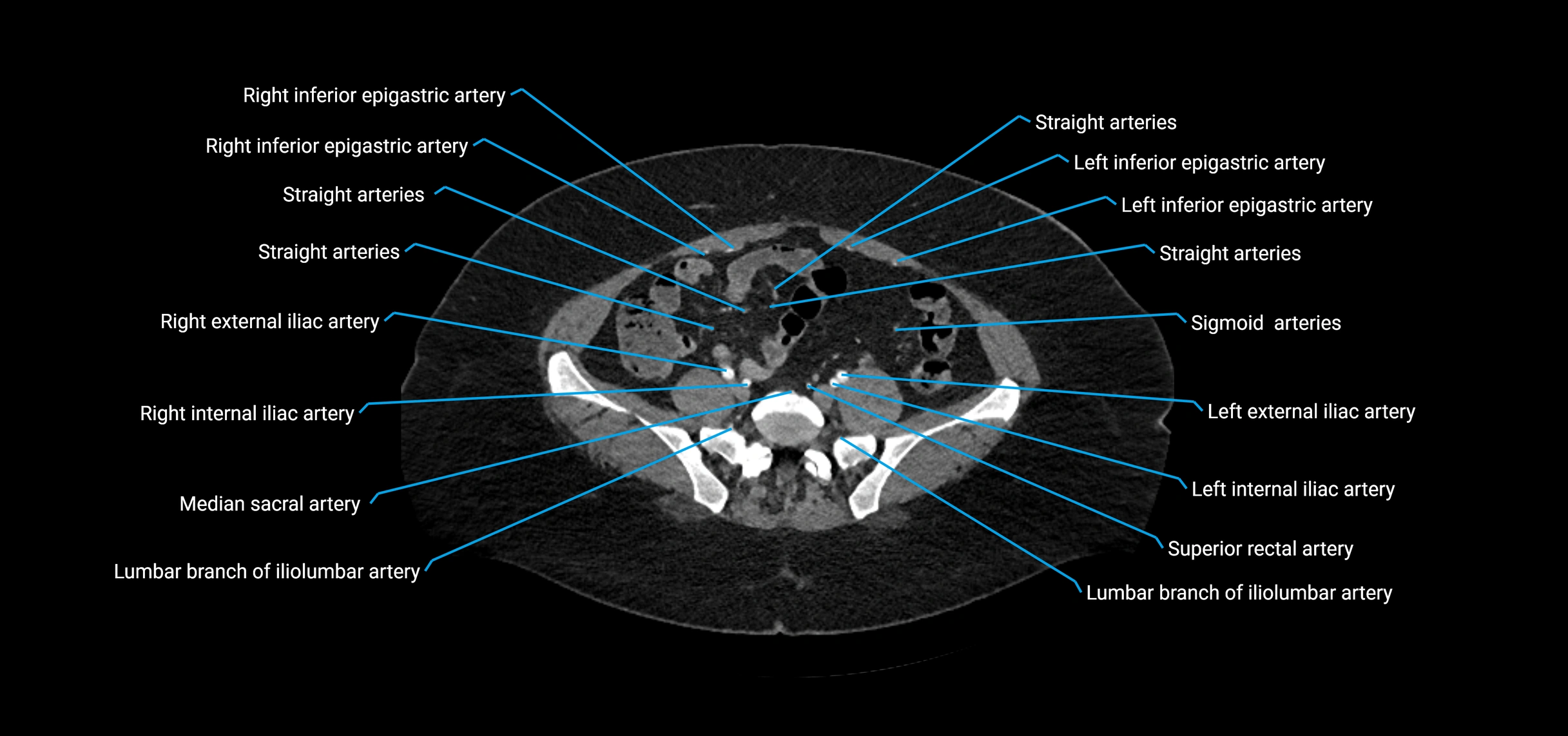 CTA abdomen axial cross sectional anatomy labelled image_175 (2).webp
